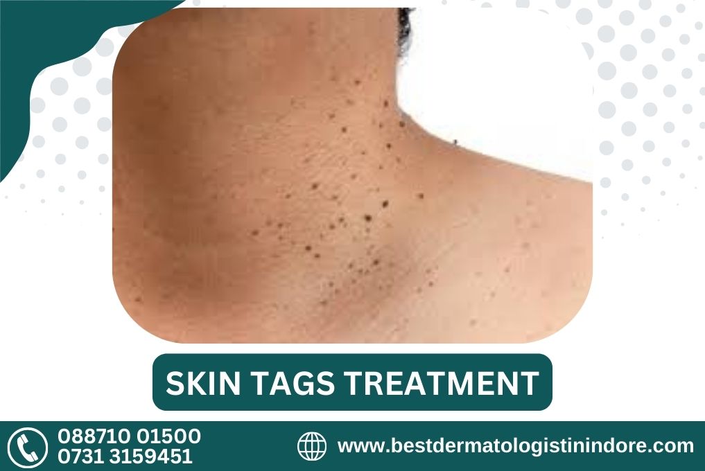 Best Doctor for Skin Tags in Indore